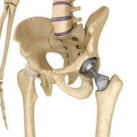 Baltimore Medical Malpractice Lawyers disccus complications stemming from hip implants. 